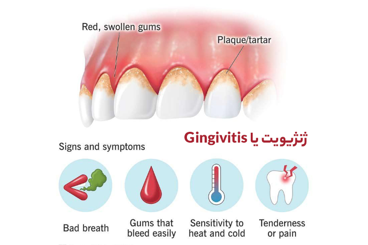 دلیل اصلی خون‌ریزی لثه، ژنژیویت است که به آن بیماری ابتدایی لثه هم می‌گویند.
